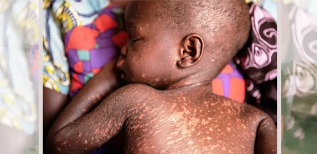  Almost half of African countries battling measles outbreak